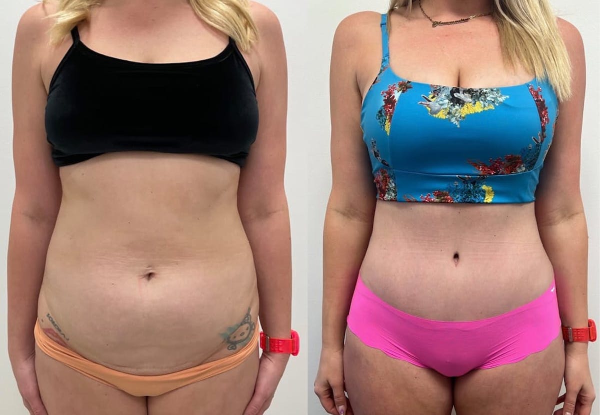 Tummy Tuck Before & After Gallery - Patient 107631 - Image 1
