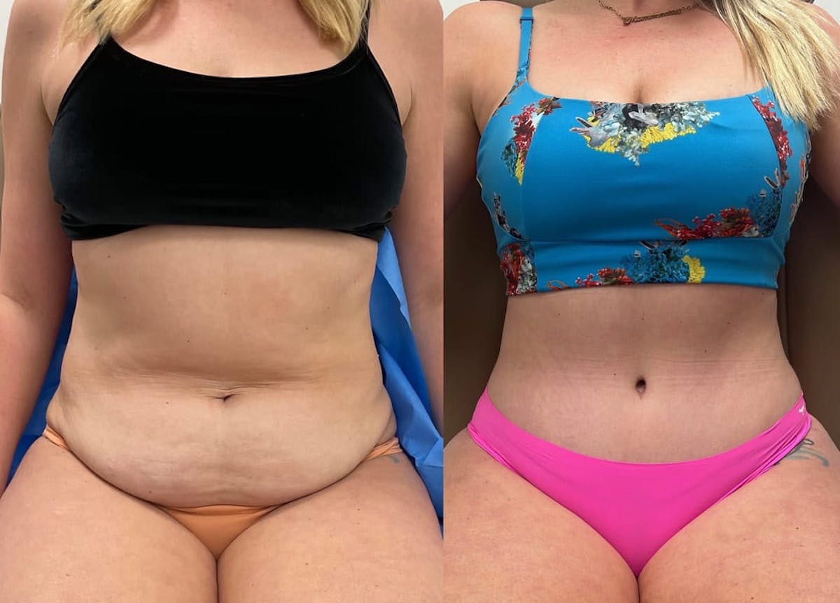 Tummy Tuck Before & After Gallery - Patient 107631 - Image 2