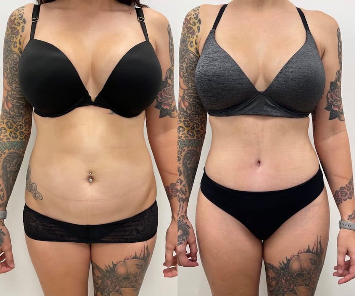Tummy Tuck Before & After Gallery - Patient 172318 - Image 1