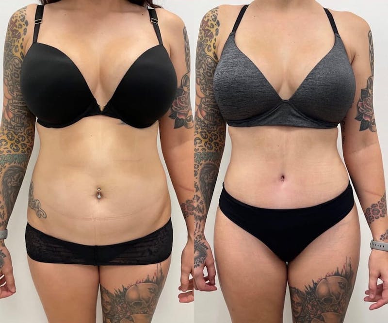 Tummy Tuck Before & After Gallery - Patient 172318 - Image 1
