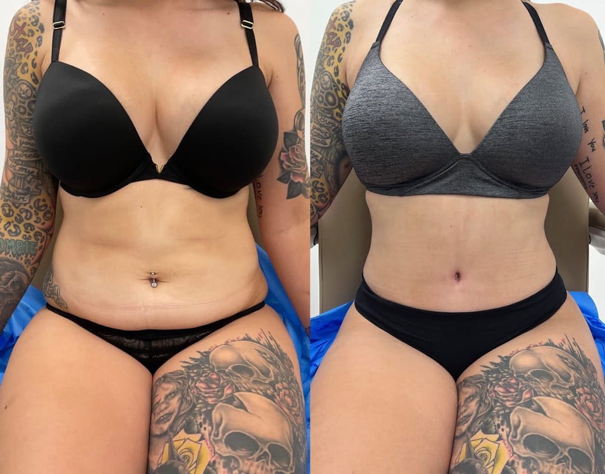Tummy Tuck Before & After Gallery - Patient 172318 - Image 2