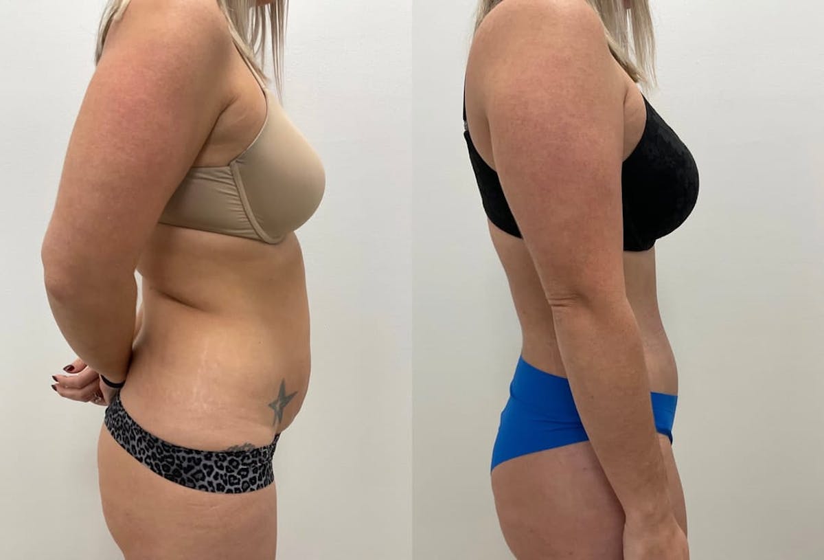 Tummy Tuck Before & After Gallery - Patient 414368 - Image 2