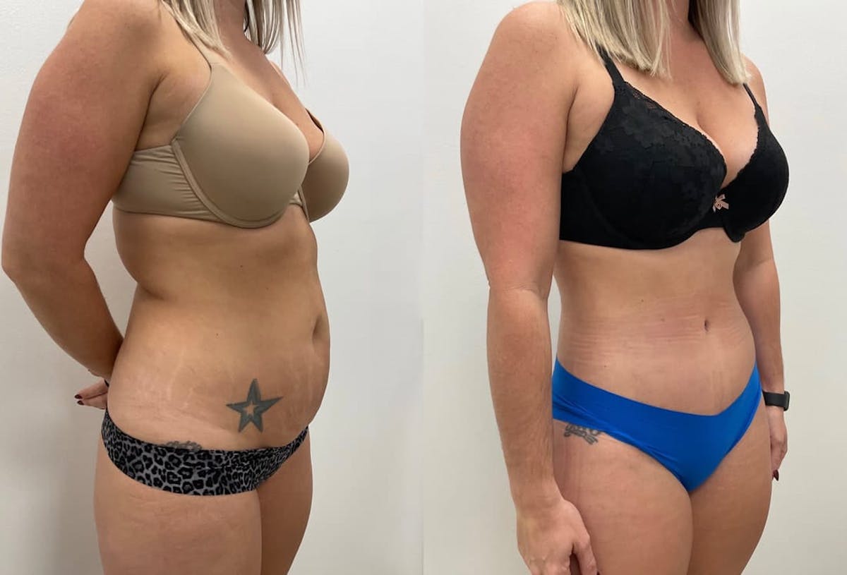 Tummy Tuck Before & After Gallery - Patient 414368 - Image 3