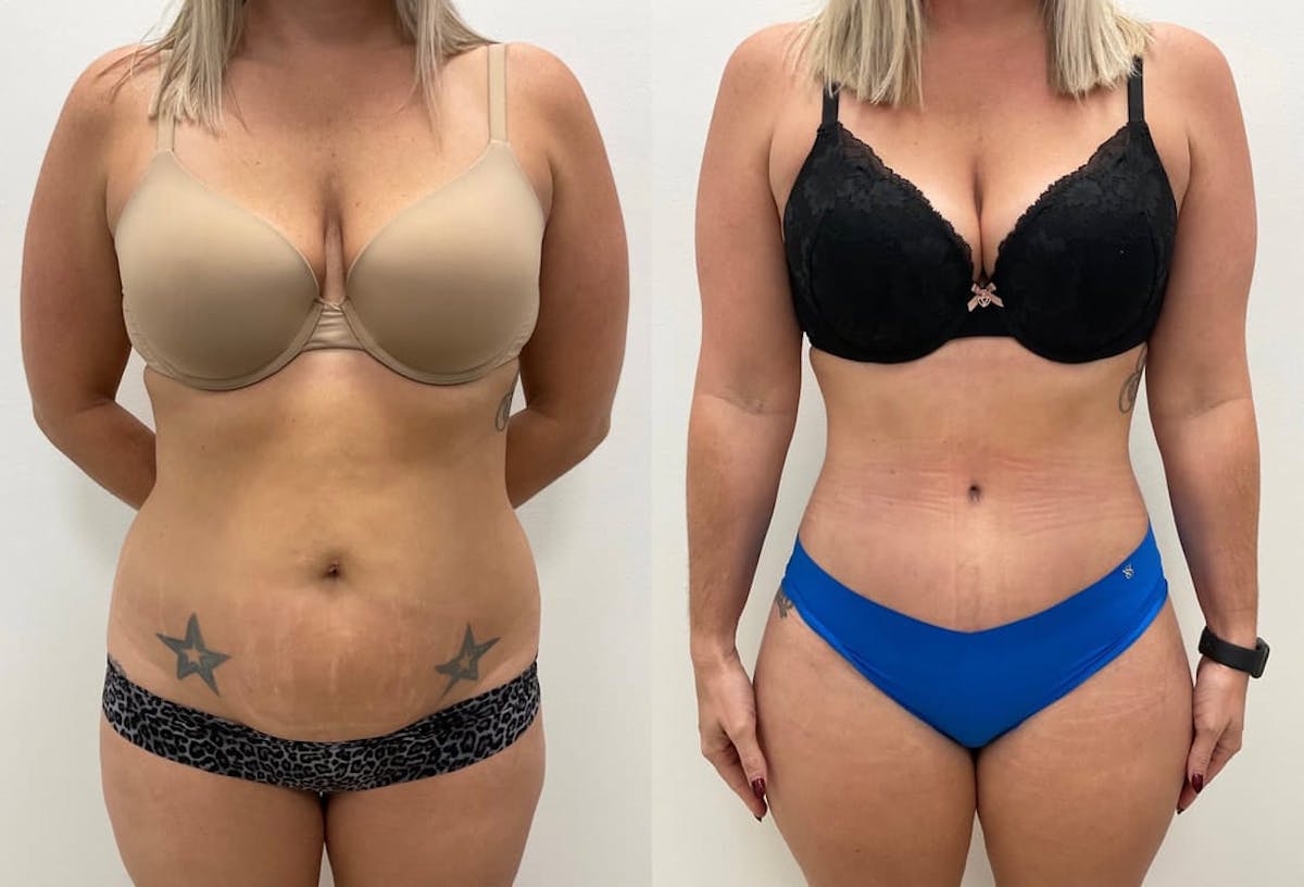 Tummy Tuck Before & After Gallery - Patient 414368 - Image 1