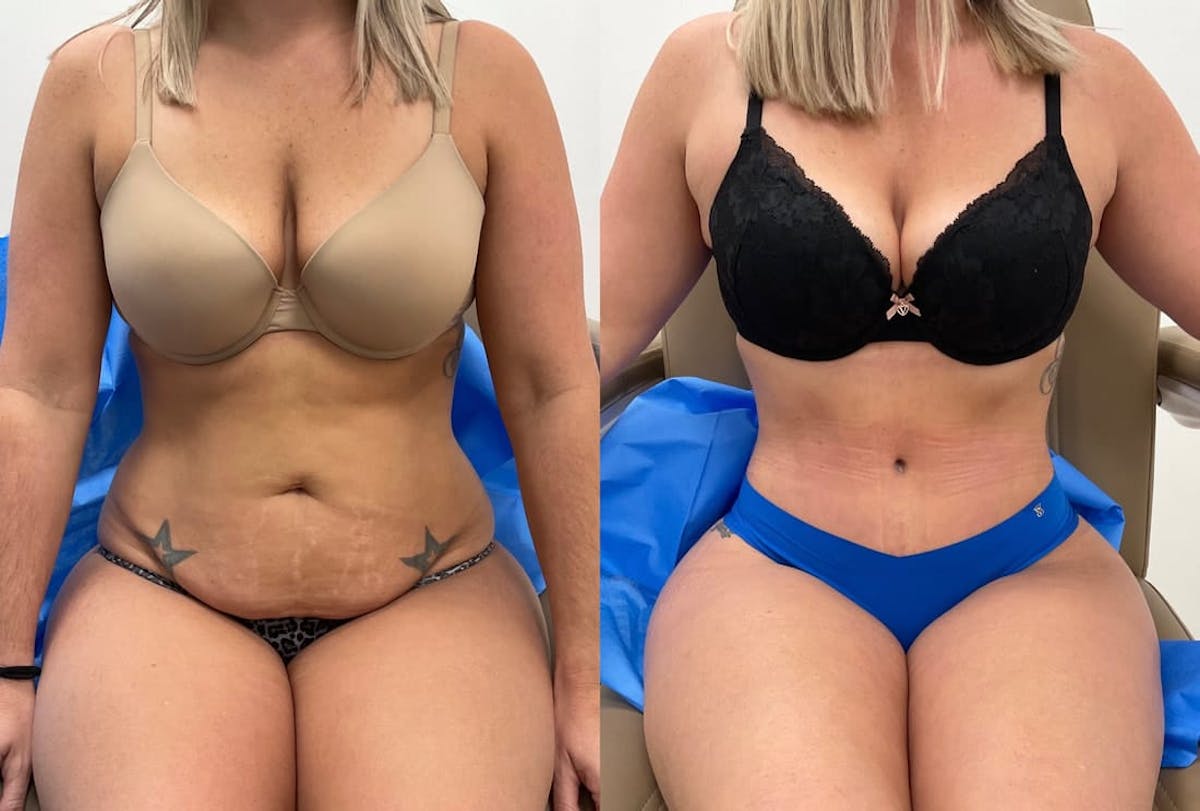 Tummy Tuck Before & After Gallery - Patient 414368 - Image 4
