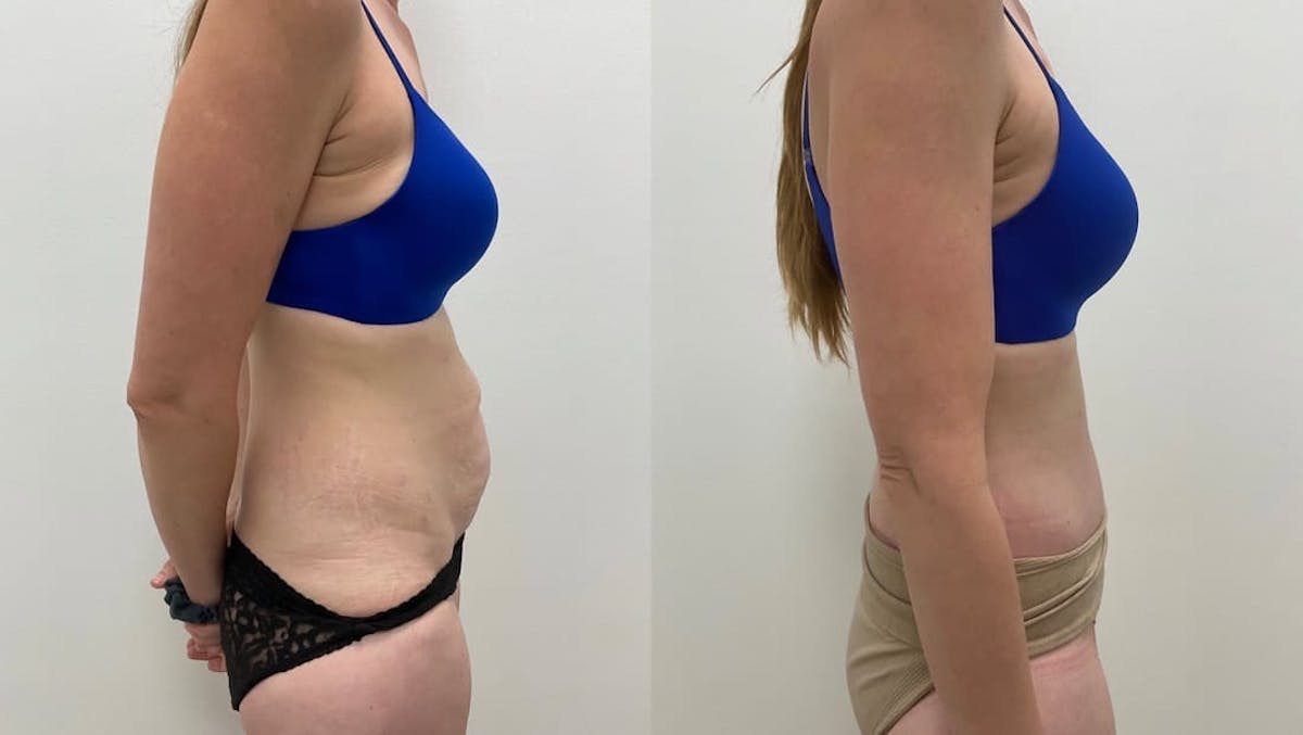 Tummy Tuck Before & After Gallery - Patient 389689 - Image 2