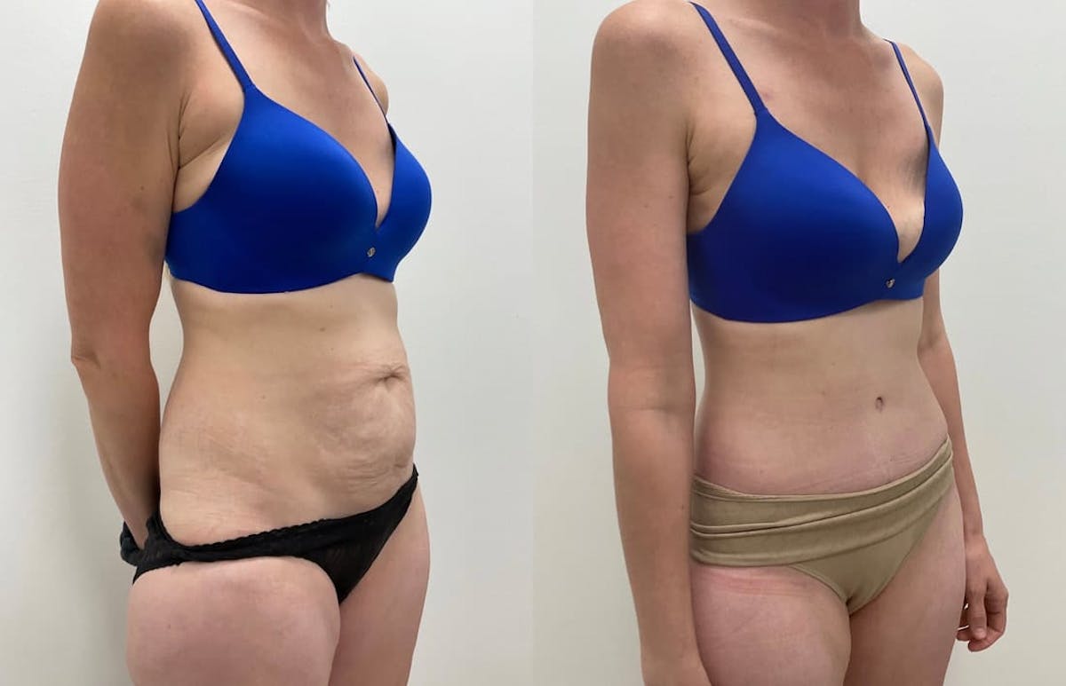 Tummy Tuck Before & After Gallery - Patient 389689 - Image 3