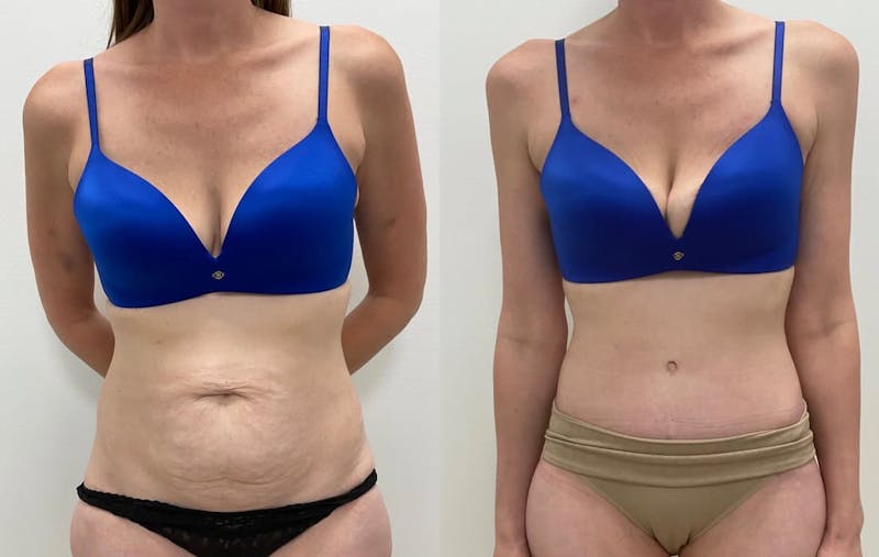 Tummy Tuck Before & After Gallery - Patient 389689 - Image 1