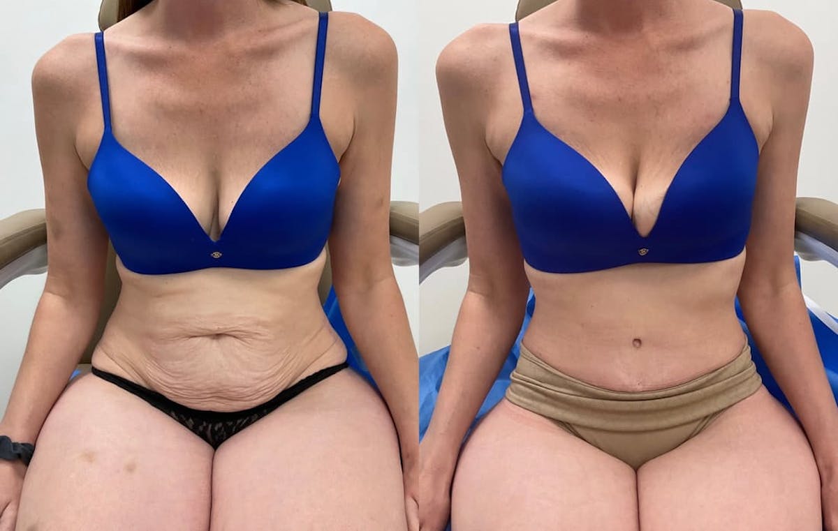 Tummy Tuck Before & After Gallery - Patient 389689 - Image 4
