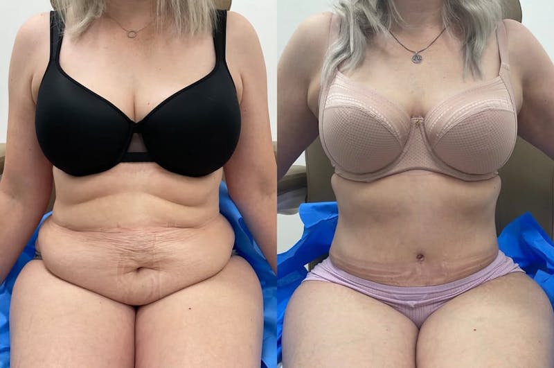 Tummy Tuck Before & After Gallery - Patient 910425 - Image 1