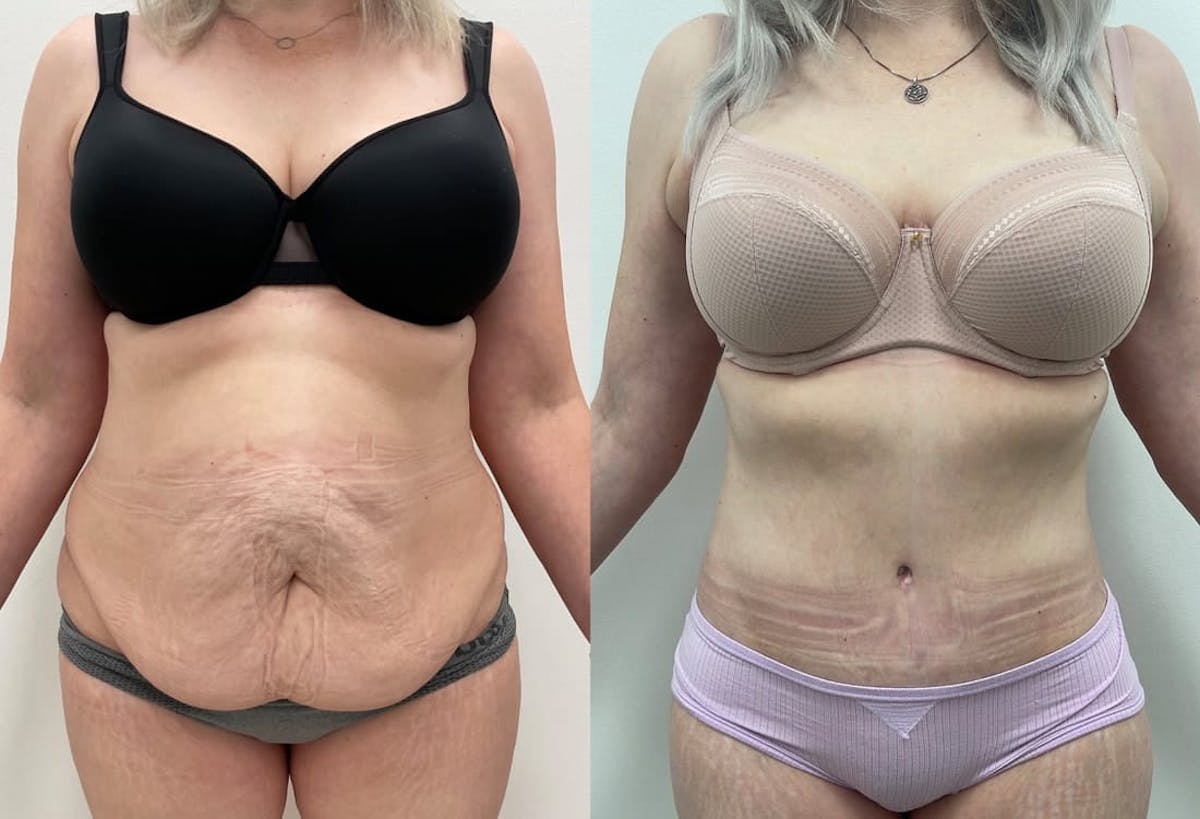 Tummy Tuck Before & After Gallery - Patient 910425 - Image 2
