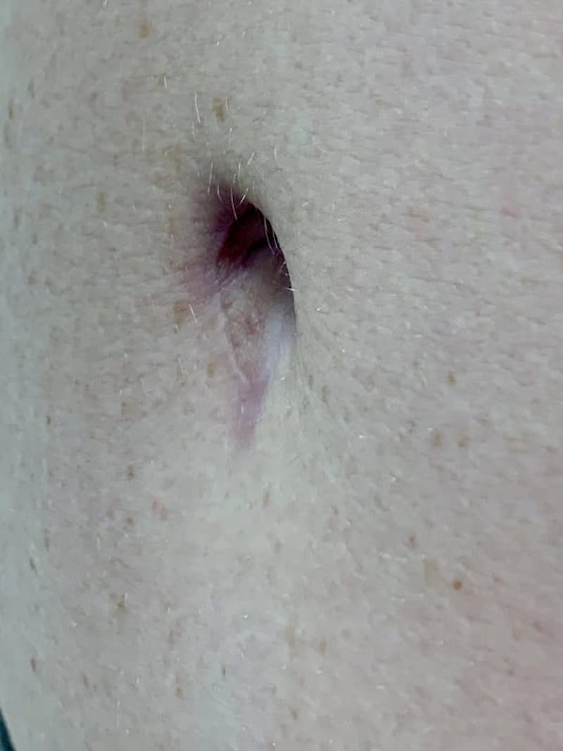 Belly Button Before & After Gallery - Patient 171800 - Image 1