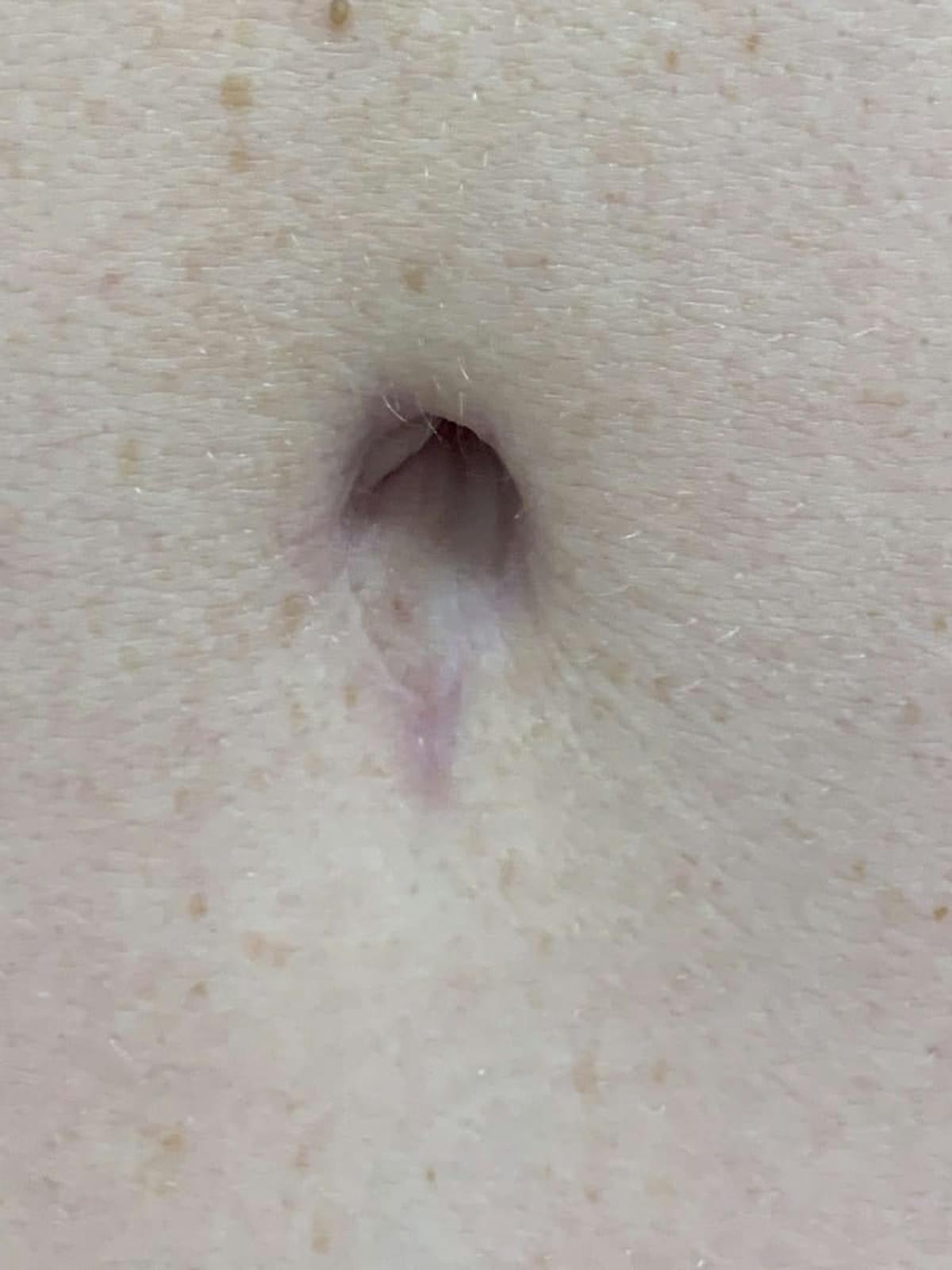 Belly Button Before & After Gallery - Patient 171800 - Image 2