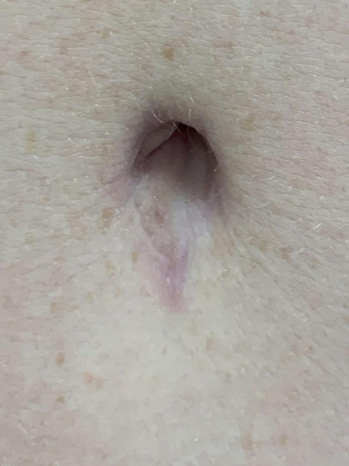 Belly Button Before & After Gallery - Patient 171800 - Image 3