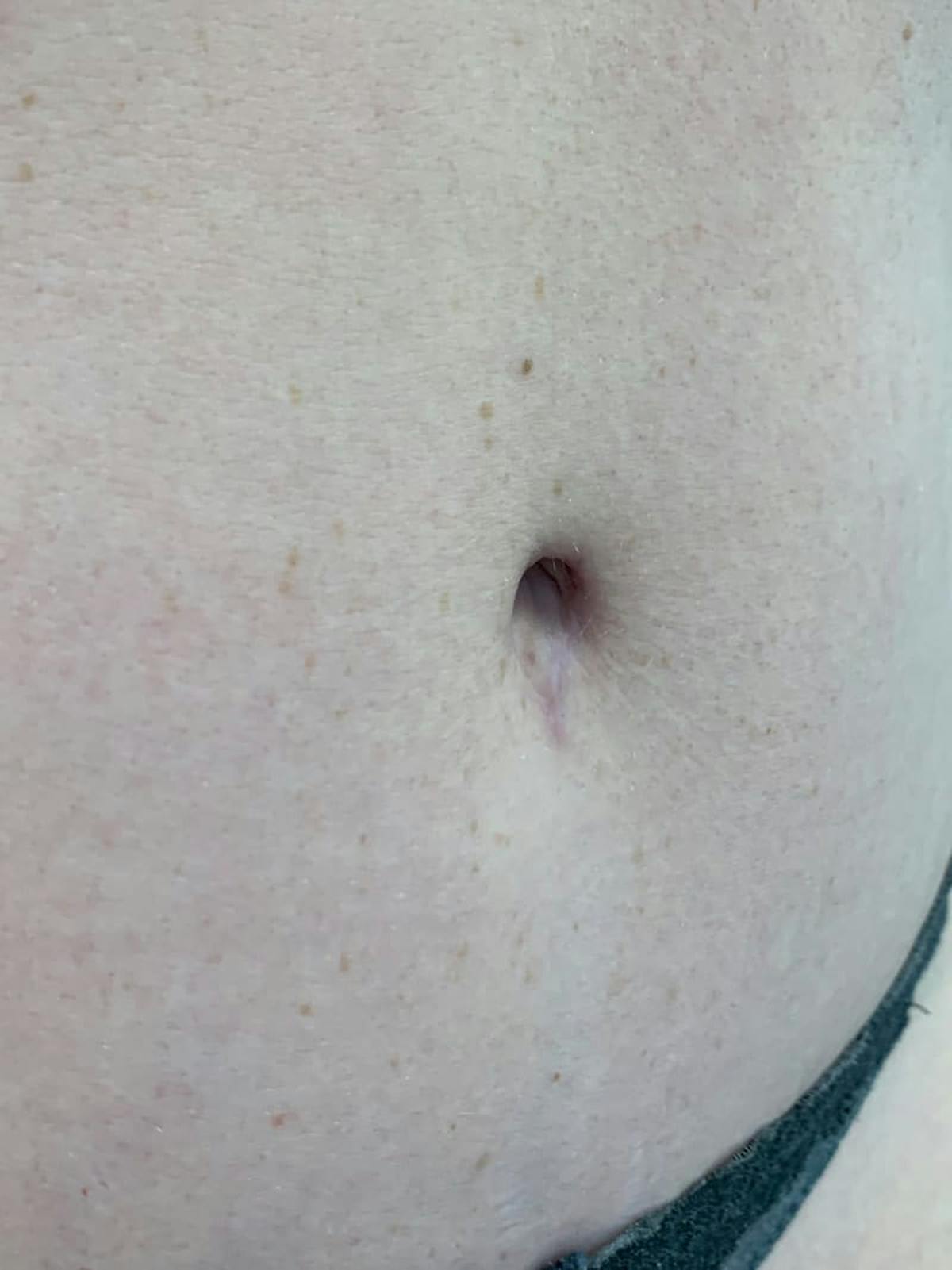 Belly Button Before & After Gallery - Patient 171800 - Image 4