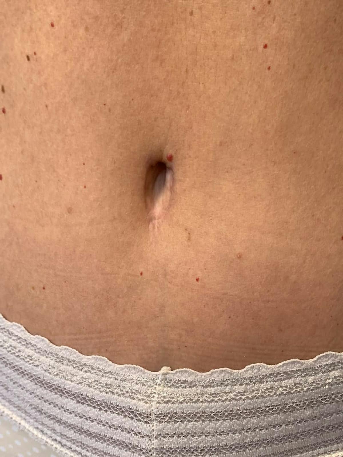 Belly Button Before & After Gallery - Patient 900670 - Image 1