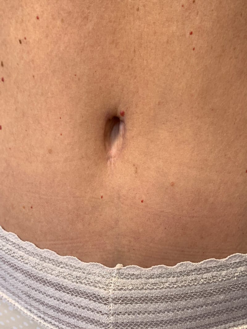Belly Button Before & After Gallery - Patient 900670 - Image 1