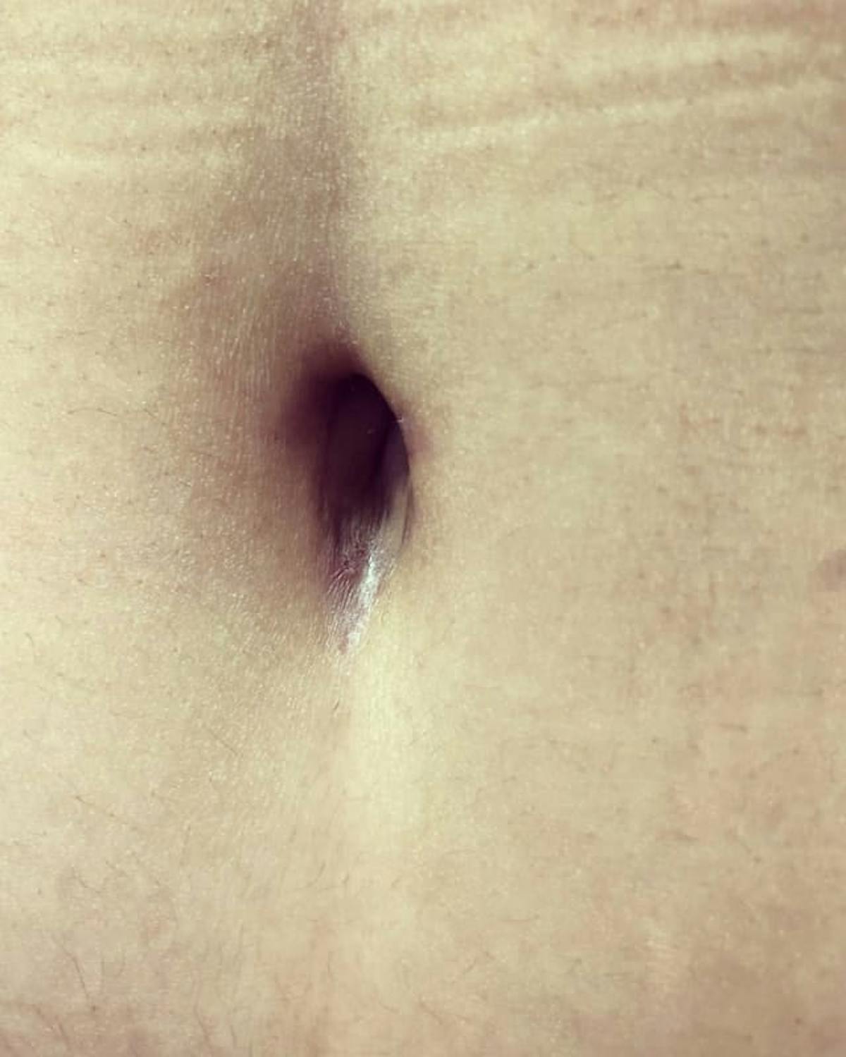 Belly Button Before & After Gallery - Patient 162998 - Image 1