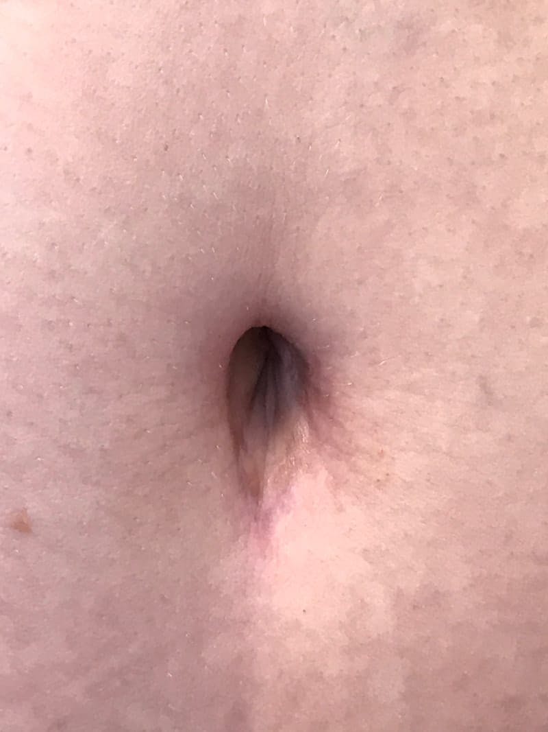 Belly Button Before & After Gallery - Patient 415703 - Image 1
