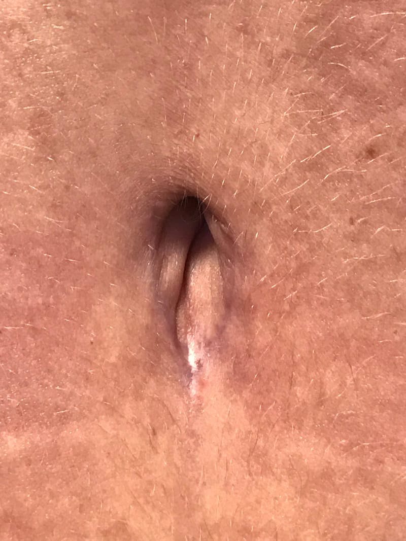 Belly Button Before & After Gallery - Patient 413847 - Image 1