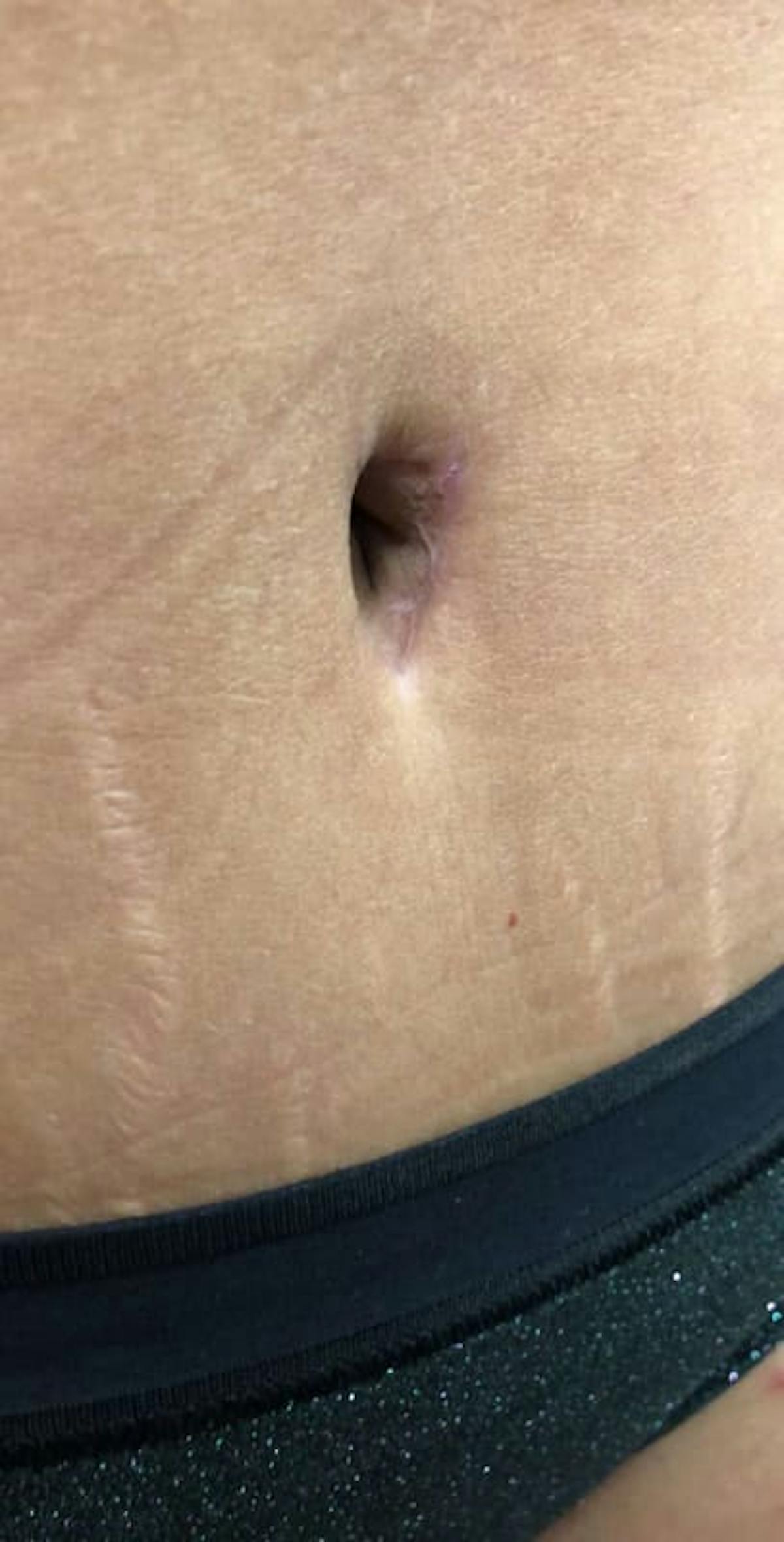 Belly Button Before & After Gallery - Patient 205228 - Image 1