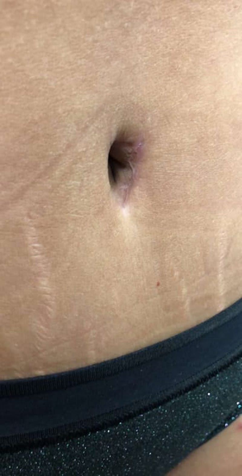 Belly Button Before & After Gallery - Patient 205228 - Image 1