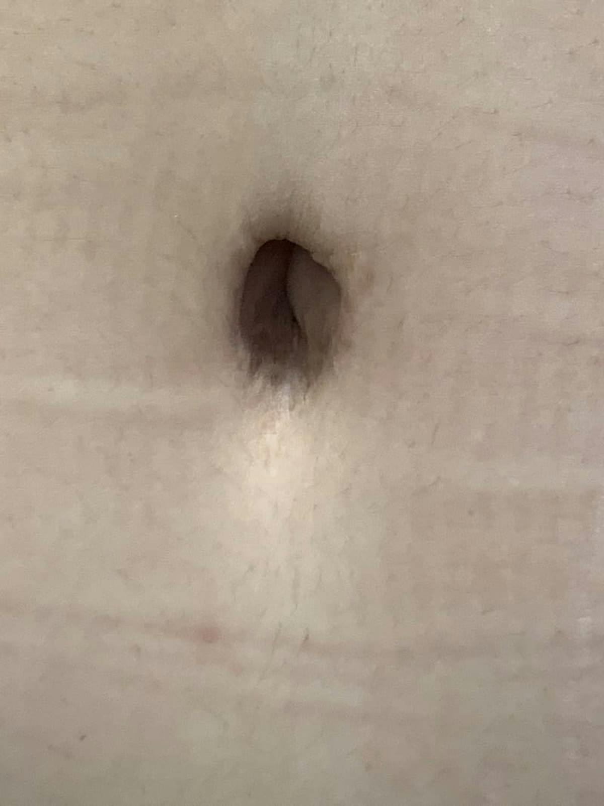 Belly Button Before & After Gallery - Patient 374974 - Image 1