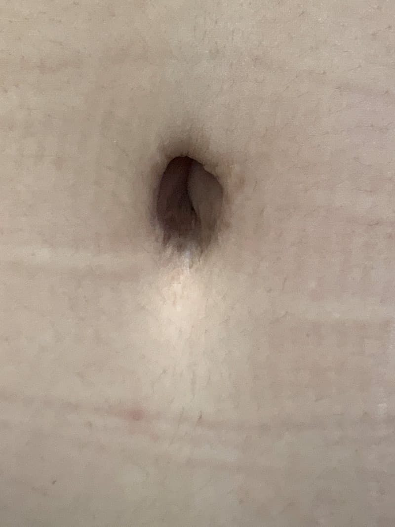 Belly Button Before & After Gallery - Patient 374974 - Image 1