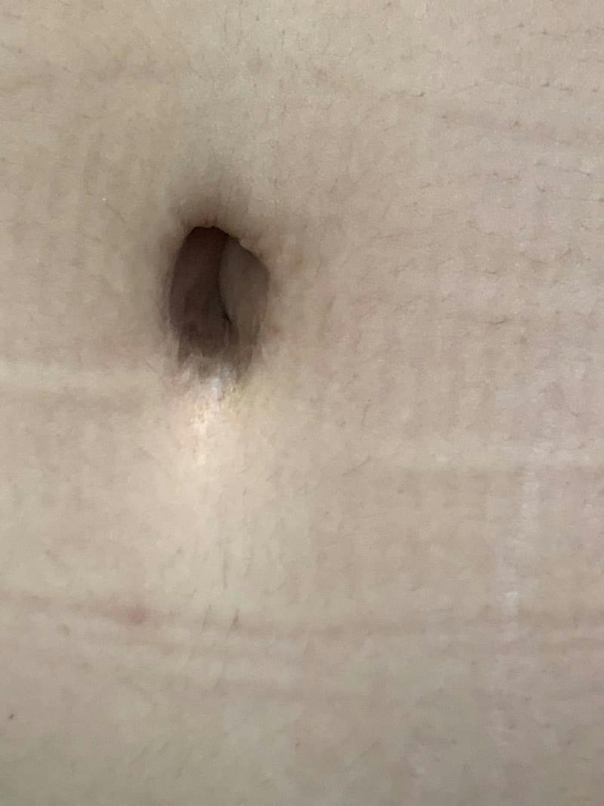 Belly Button Before & After Gallery - Patient 374974 - Image 2