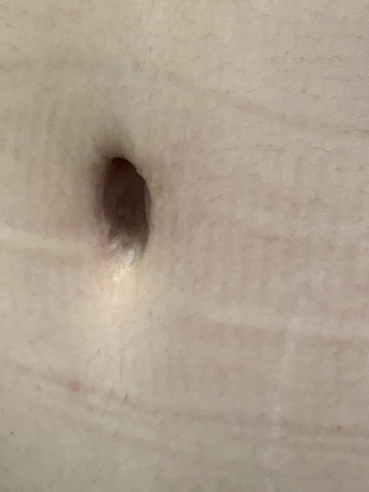 Belly Button Before & After Gallery - Patient 374974 - Image 3