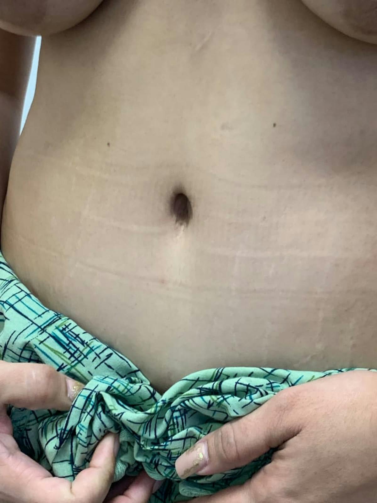 Belly Button Before & After Gallery - Patient 374974 - Image 4