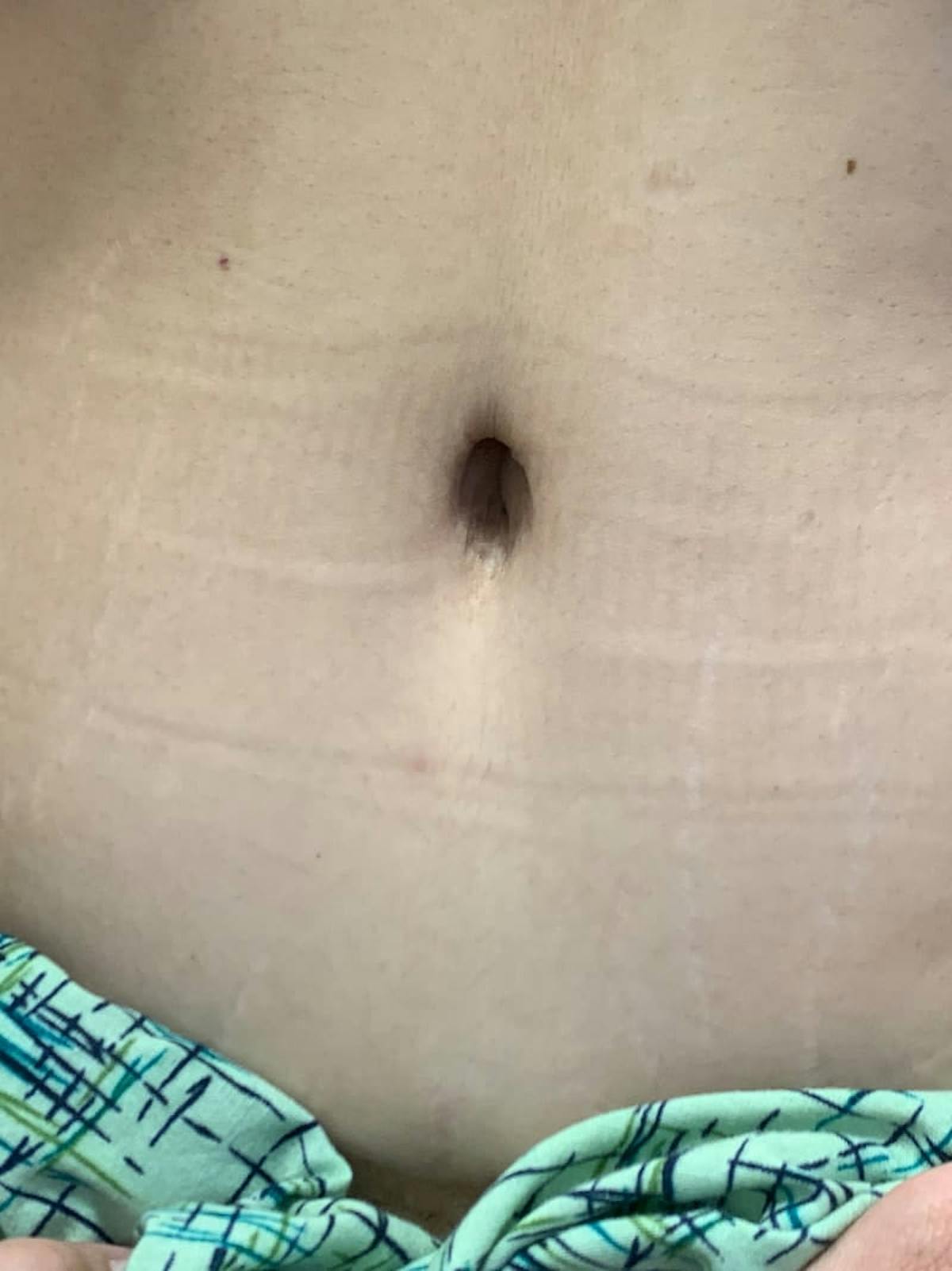 Belly Button Before & After Gallery - Patient 374974 - Image 5