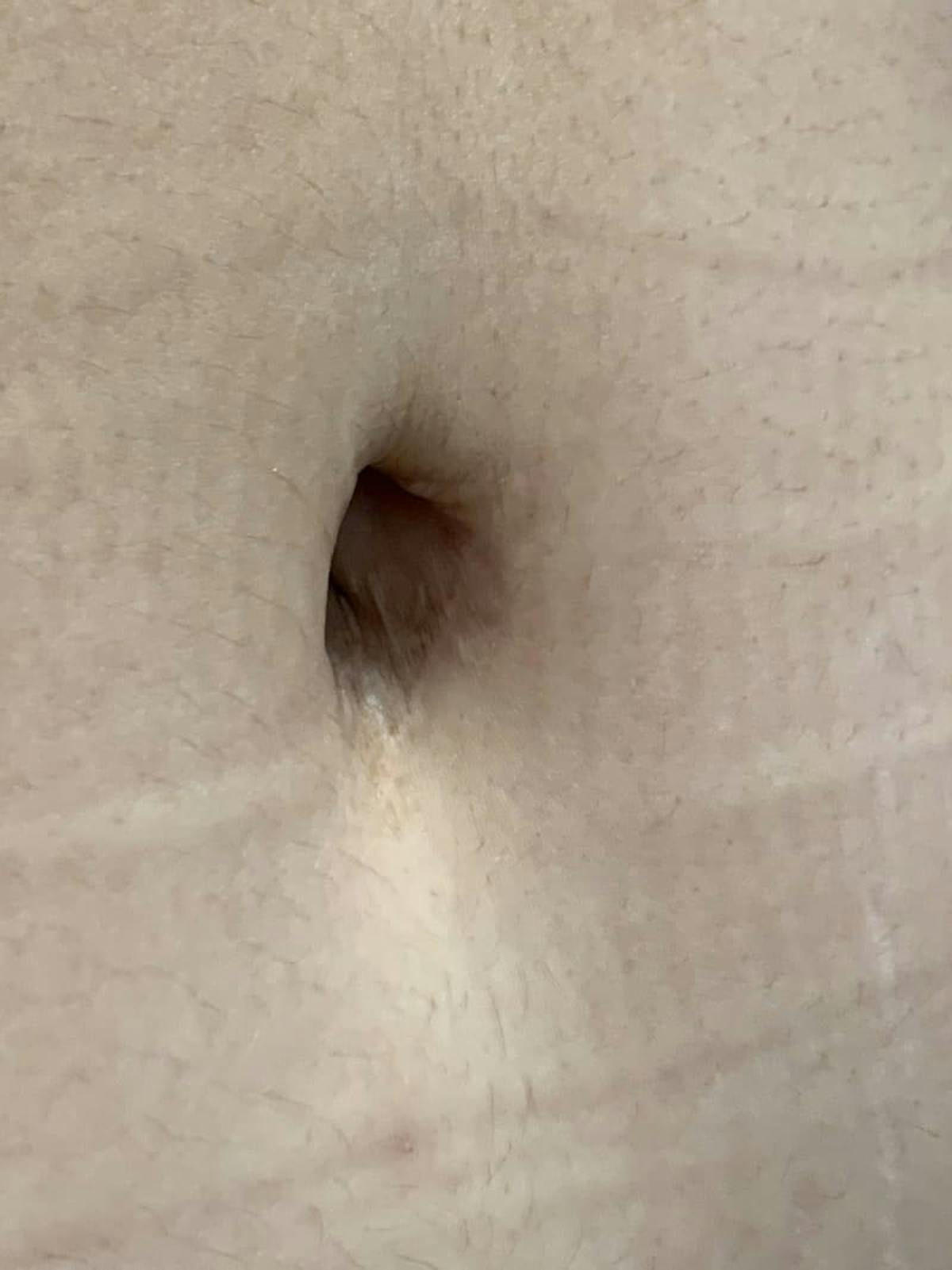 Belly Button Before & After Gallery - Patient 374974 - Image 7