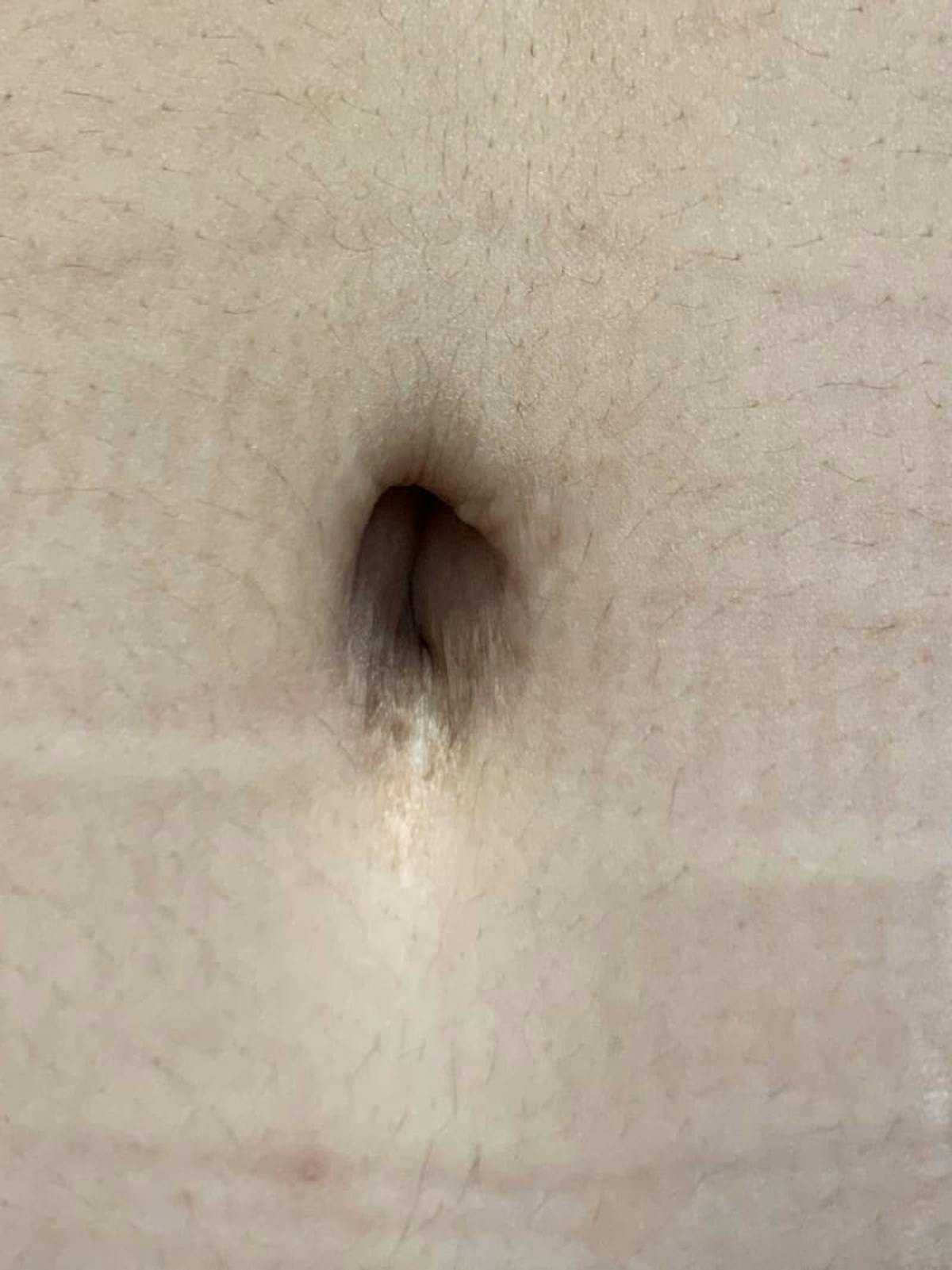 Belly Button Before & After Gallery - Patient 374974 - Image 8
