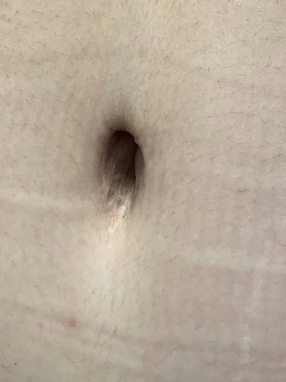 Belly Button Before & After Gallery - Patient 374974 - Image 9