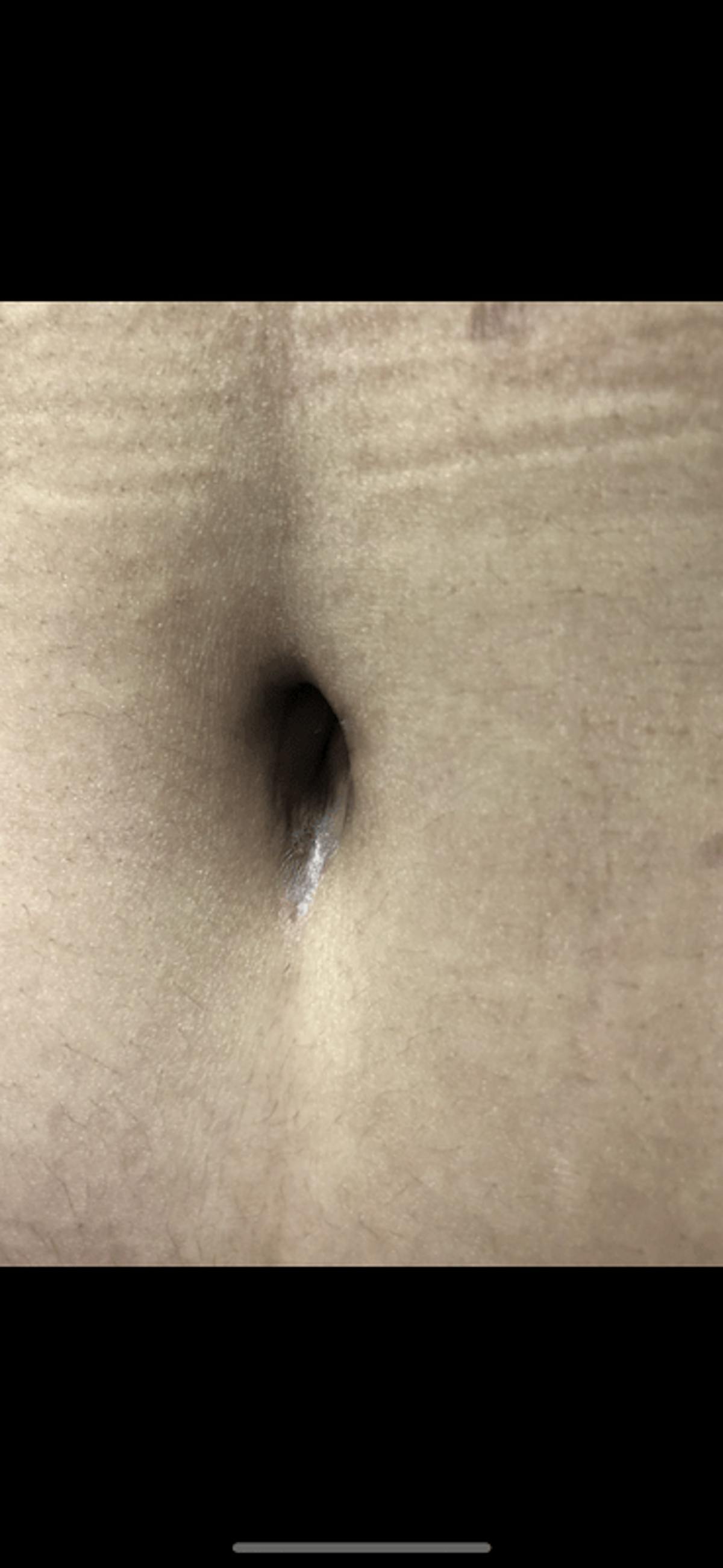 Belly Button Before & After Gallery - Patient 232402 - Image 1