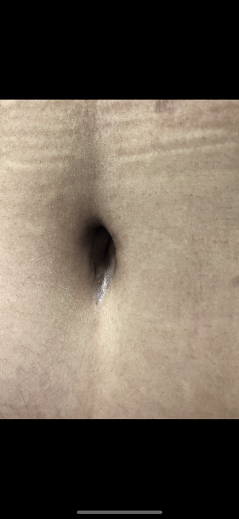 Belly Button Before & After Gallery - Patient 232402 - Image 1