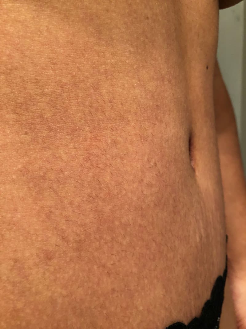 Belly Button Before & After Gallery - Patient 231091 - Image 1