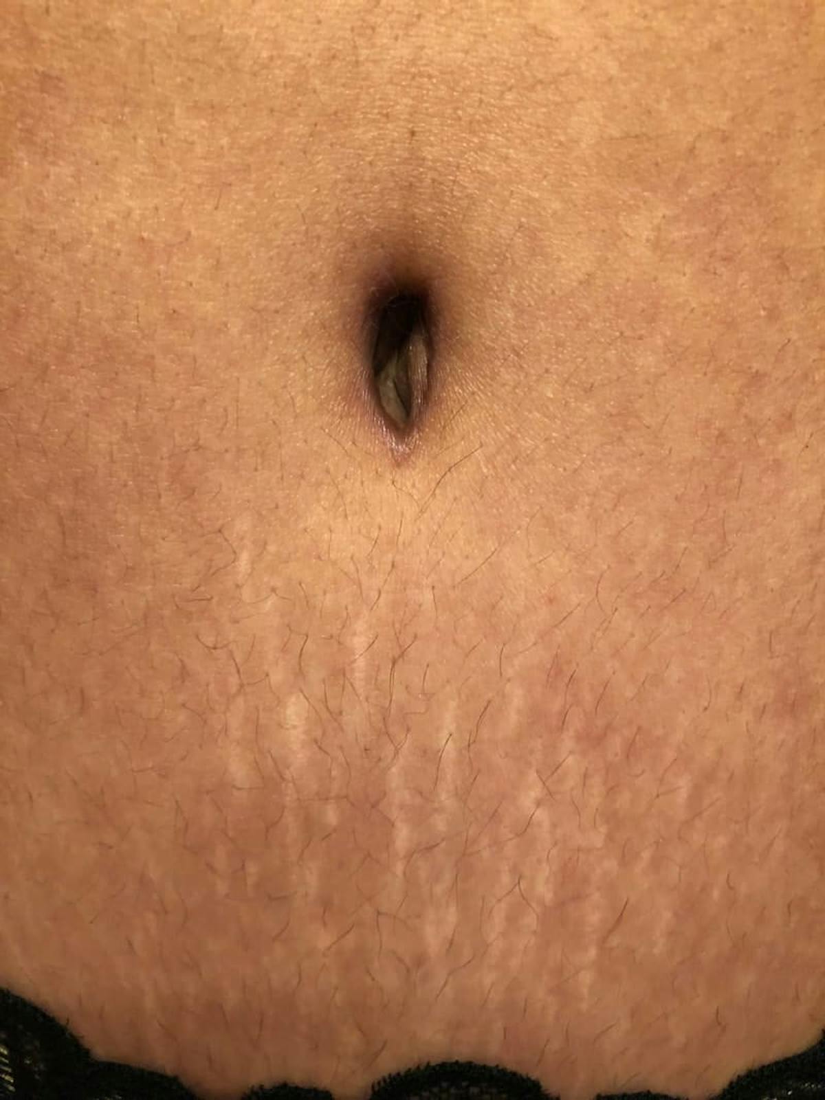 Belly Button Before & After Gallery - Patient 231091 - Image 2