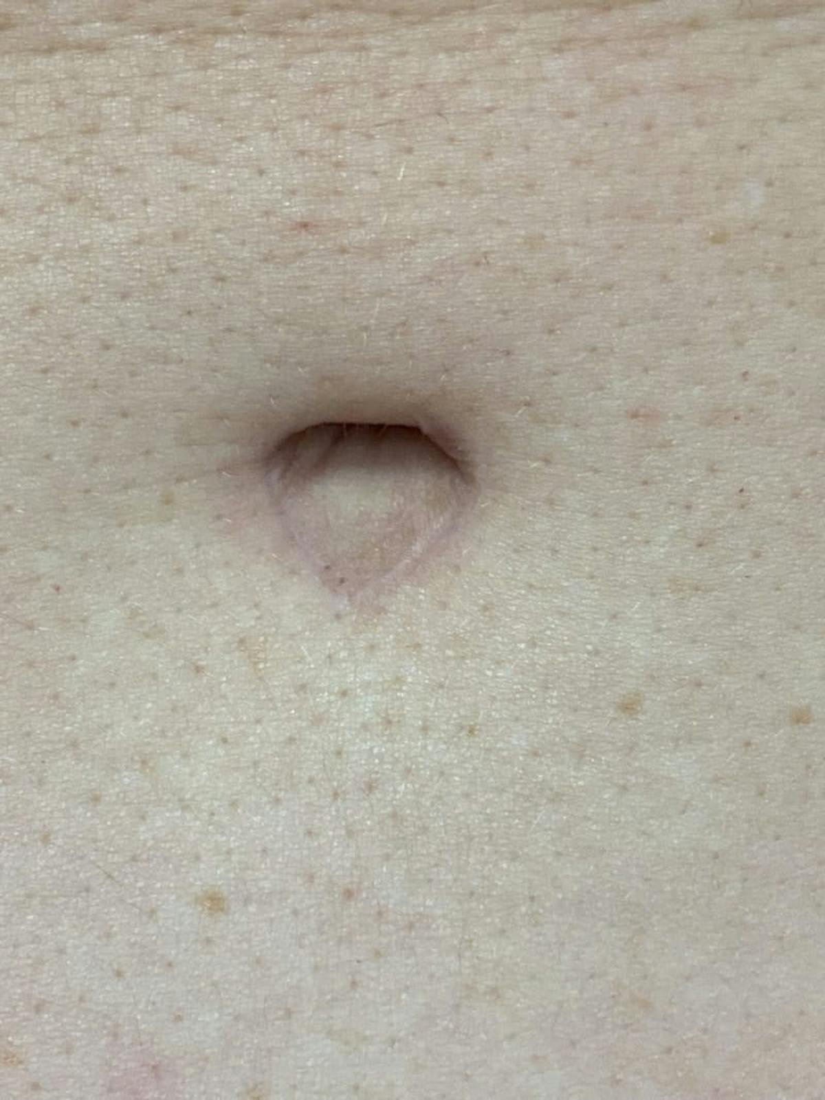 Belly Button Before & After Gallery - Patient 178565 - Image 1