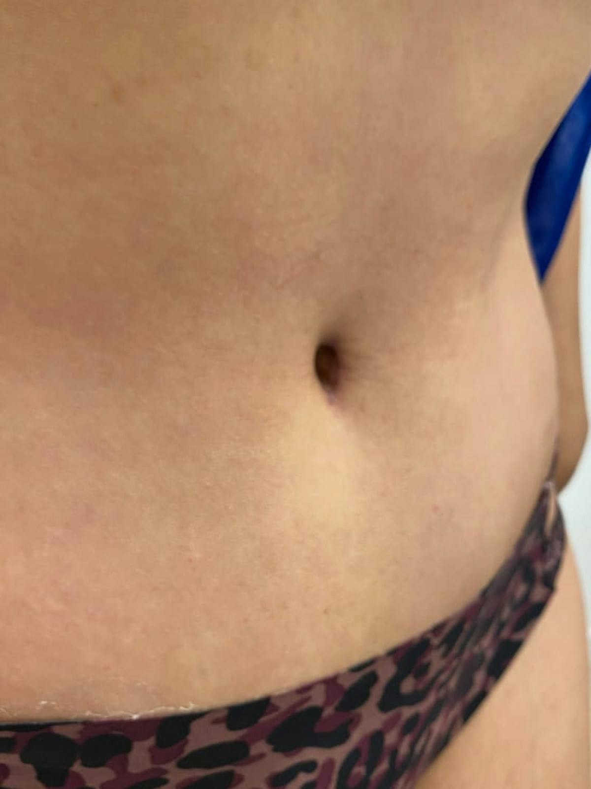 Belly Button Before & After Gallery - Patient 173250 - Image 1