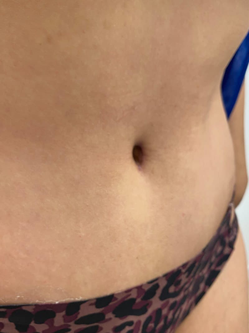 Belly Button Before & After Gallery - Patient 173250 - Image 1