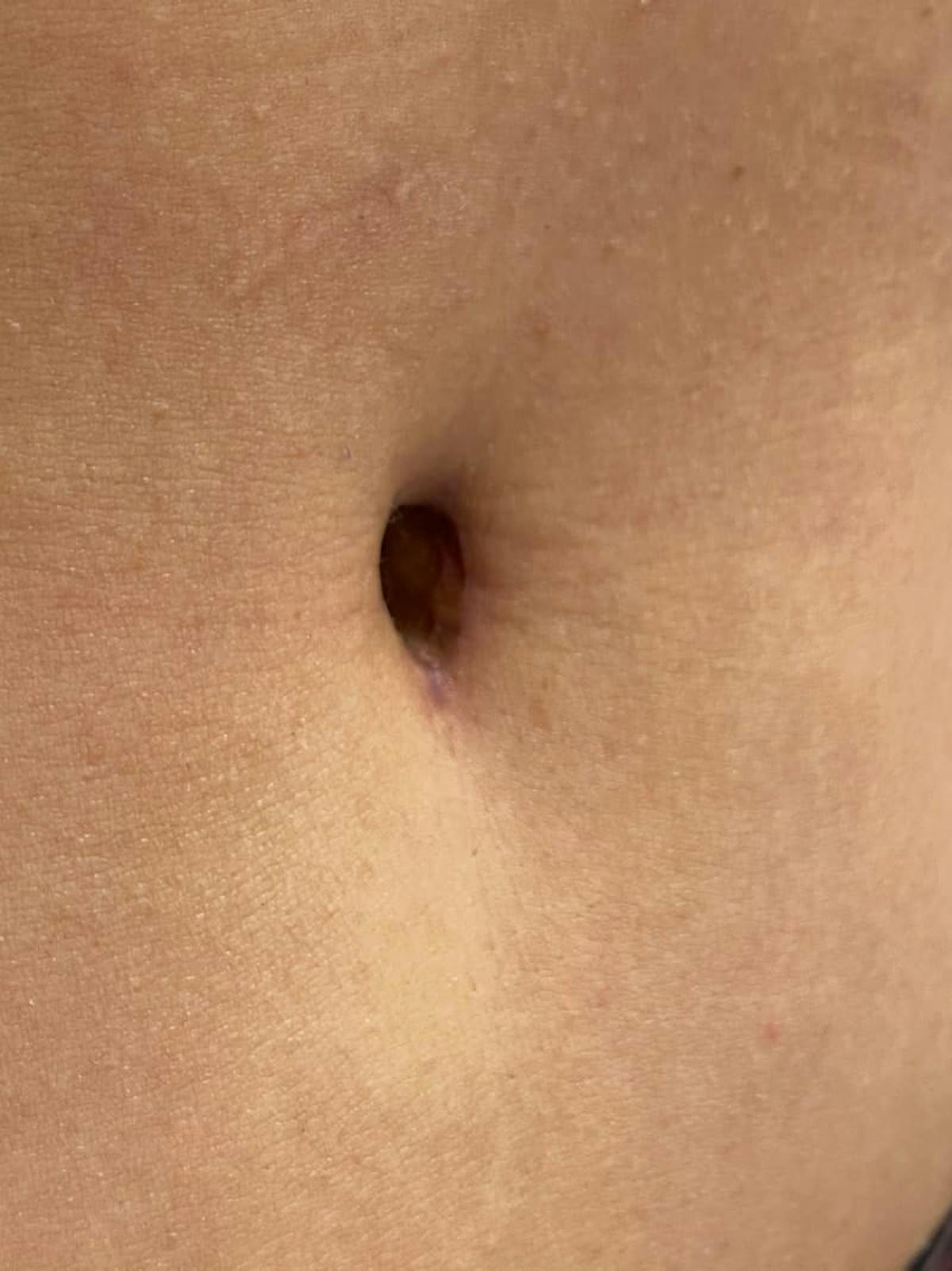 Belly Button Before & After Gallery - Patient 173250 - Image 2