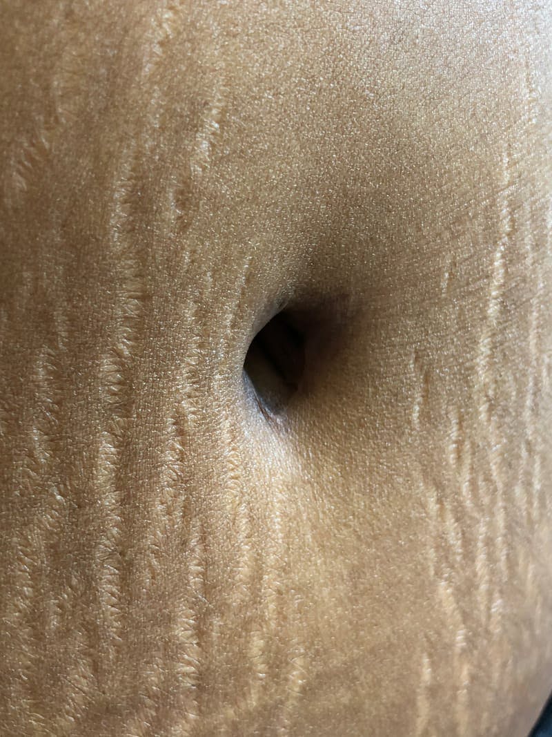 Belly Button Before & After Gallery - Patient 194305 - Image 1