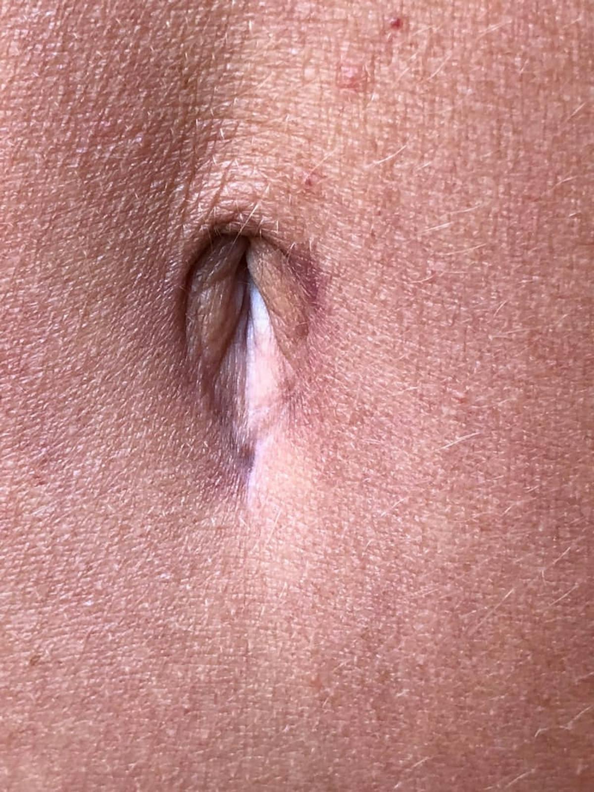 Belly Button Before & After Gallery - Patient 240846 - Image 1