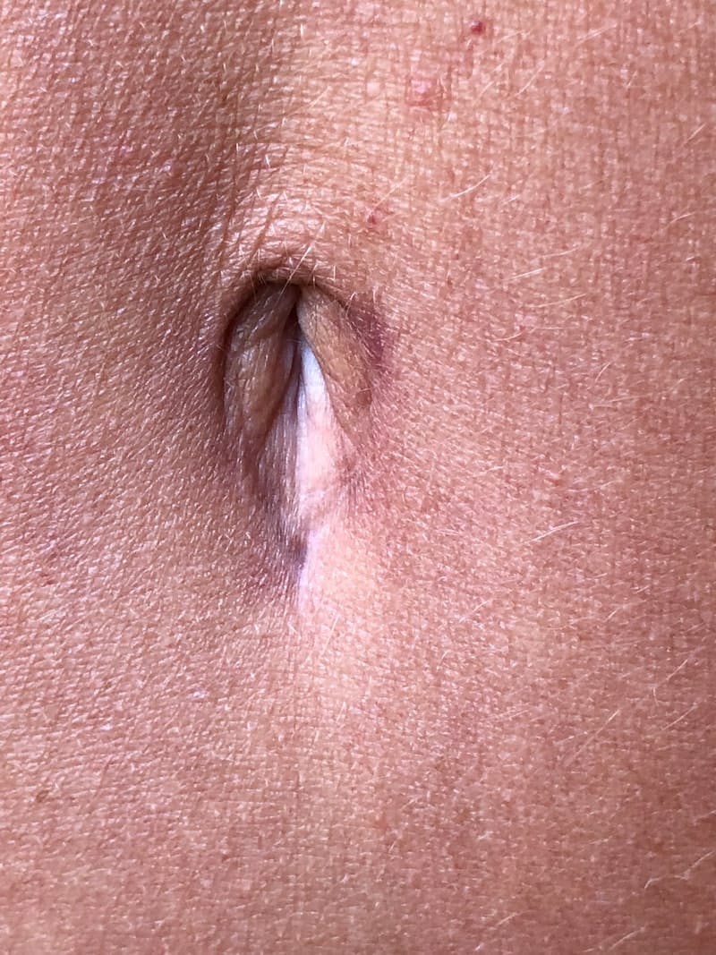 Belly Button Before & After Gallery - Patient 240846 - Image 1