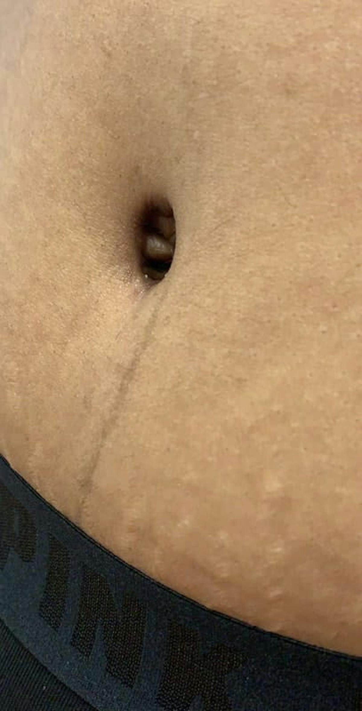 Belly Button Before & After Gallery - Patient 319903 - Image 1