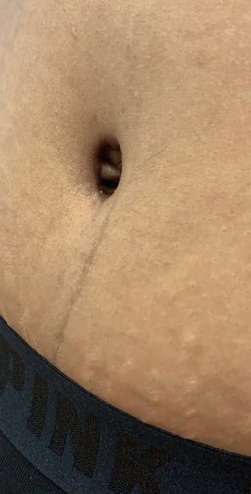 Belly Button Before & After Gallery - Patient 319903 - Image 1