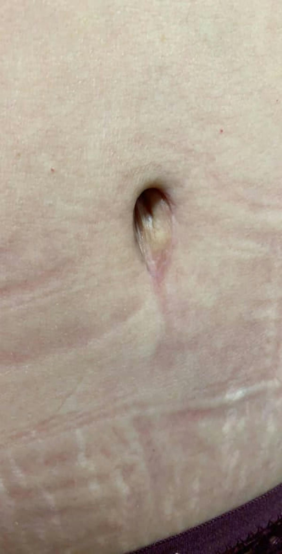 Belly Button Before & After Gallery - Patient 388528 - Image 1