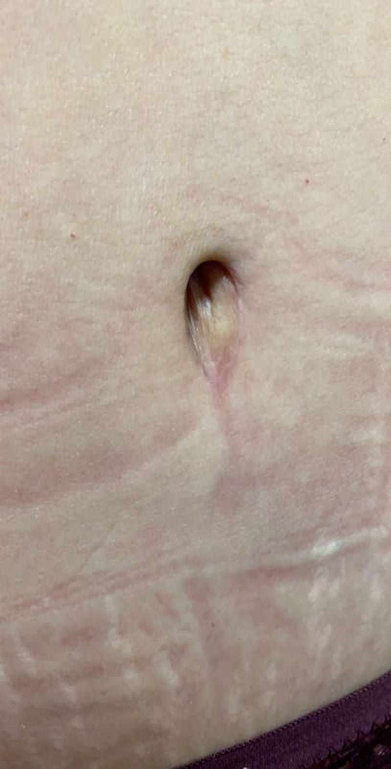 Belly Button Before & After Gallery - Patient 388528 - Image 1